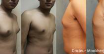 Gynecomastie et liposuccion abdomen homme