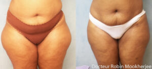 Liposuccion sur peau distendue