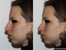 Le Morphing et la chirurgie du nez