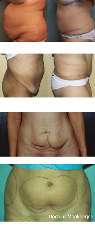 Liposuccion ou plastie abdominale ?